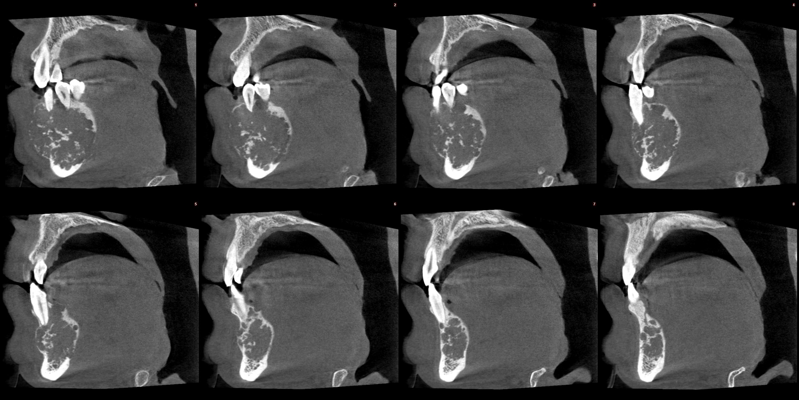 手腕骨片,顱頜面cbct,牙齒cbct的檢查以及涎腺造影,竇道 瘻管造影